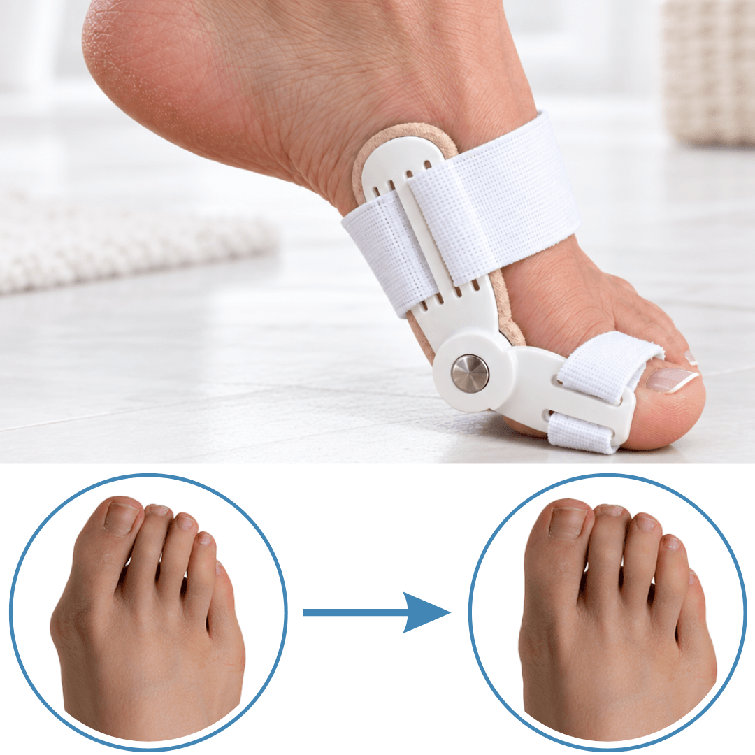 Pied portant le correcteur Pedineo®