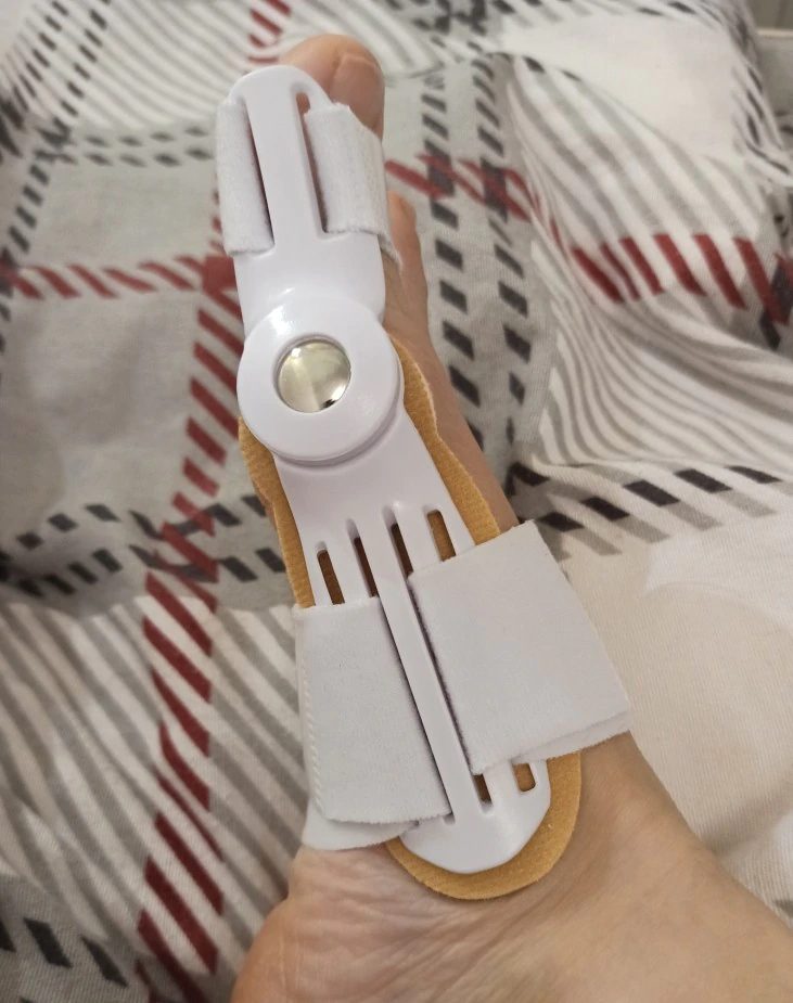Pied de Sandrine avec le correcteur Pedineo®